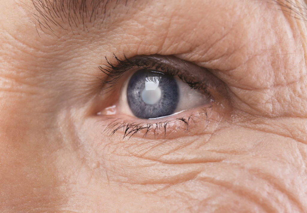 Cataract Treatments