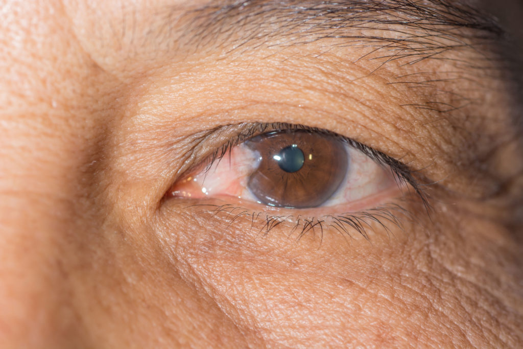 Pterygium Treatments