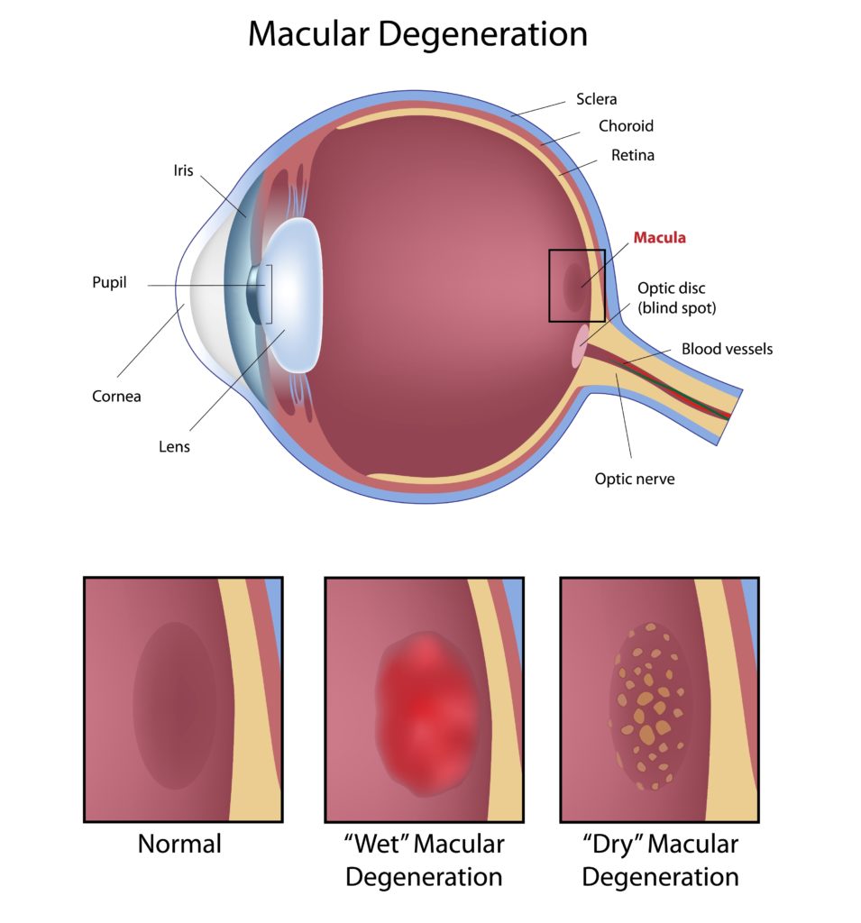 Macular Degeneration Treatments